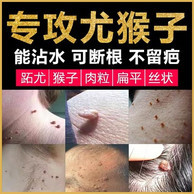 脖子上长小肉粒疙瘩m肉球的药刺猴子去除神器皮赘丝状跖疣根专用