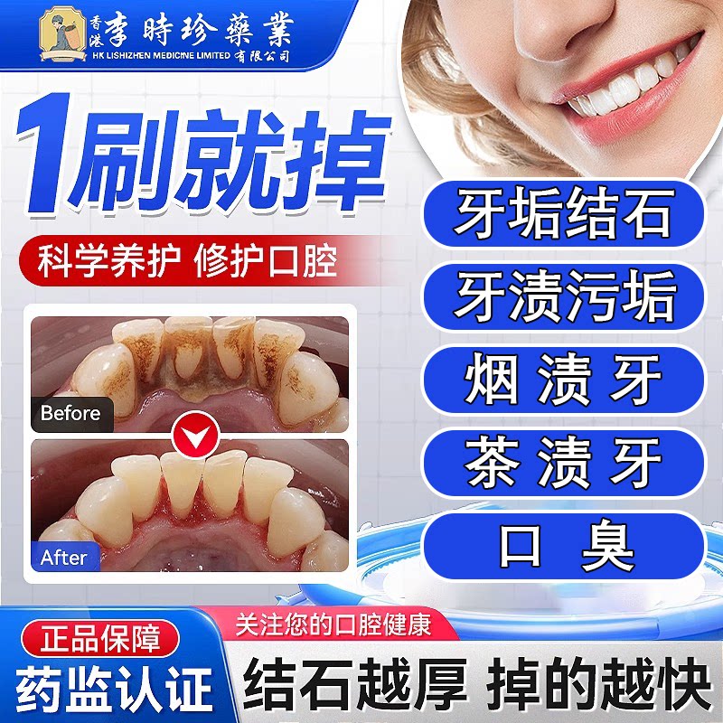 牙结石去除牙膏溶解牙石牙渍污垢专用牙膏牙龈萎缩牙黄官方正品