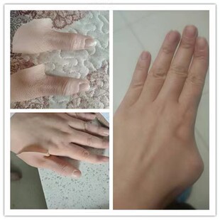 假肢义肢大拇指 仿真手指美容手指 进口硅胶美容手指套量身定做