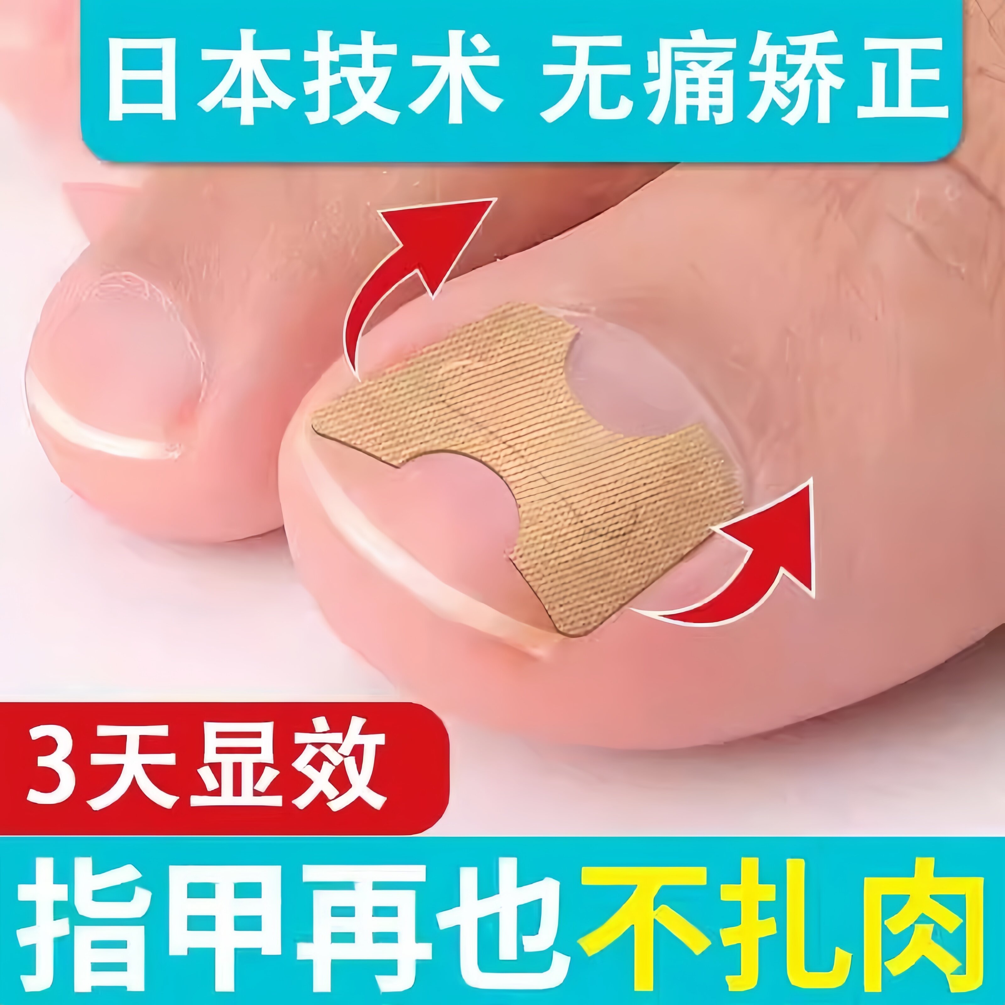甲沟矫正器日本正甲贴嵌甲脚指甲纠正器专用贴脚趾正甲片甲沟垫炎