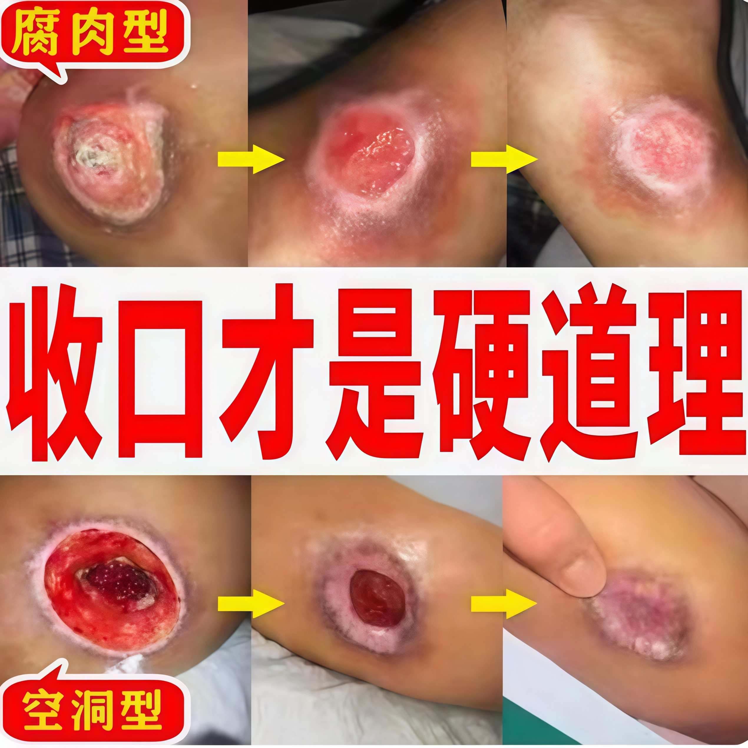 褥膏疮膏老人臀部皮肤溃烂外用伤口空洞压疮黑痂型愈合溃烂