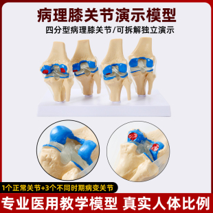 人体四阶段病理膝关m节骨骼结构解剖模型骨科展示膝盖骨质教学模