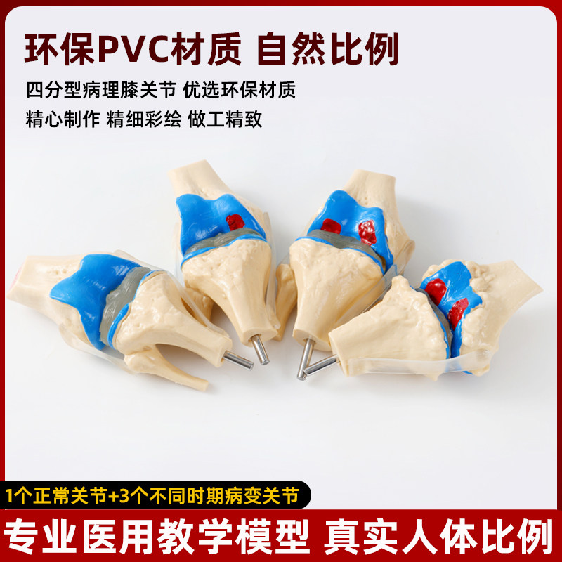 人体四阶段病理膝关节骨骼结构解剖模型骨科展示膝盖骨质教学模具