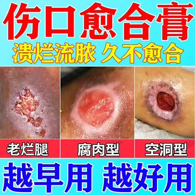 伤口愈合促进长肉快速结痂的药伤口愈合伤口感染化脓消炎杀菌修复