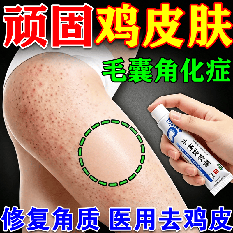 鸡皮肤疙瘩毛囊角化症专用药膏去医用除全身手臂腿水杨酸软膏正品