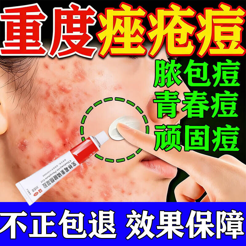 治疗重度痤疮粉刺痘痘祛痘消炎祛痘药膏正品克林霉素磷酸酯凝胶
