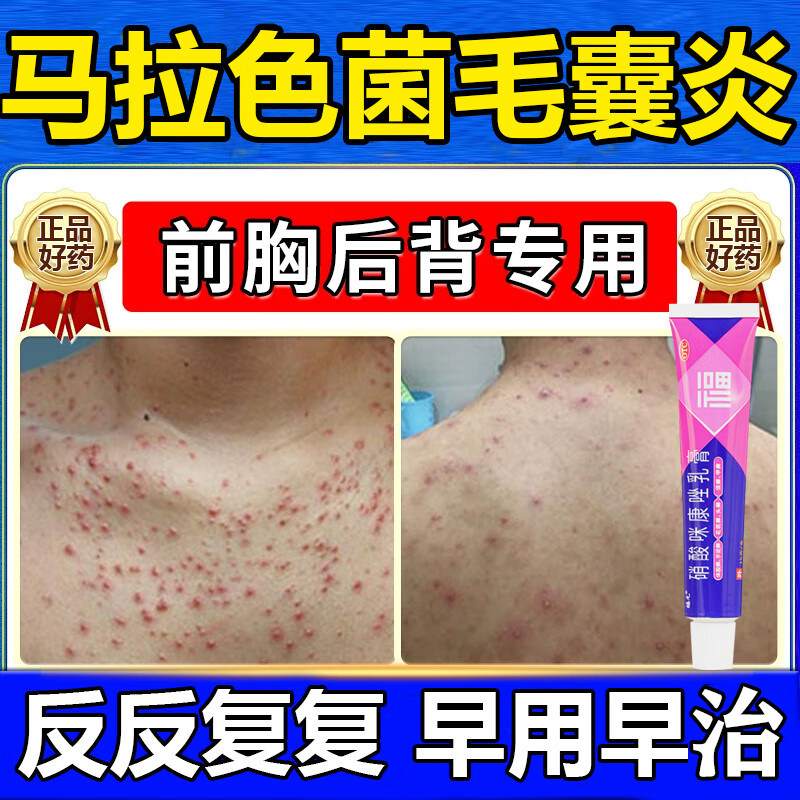 硝酸咪康唑乳膏治疗毛囊炎马拉色菌毛囊炎专用药膏前胸后背长痘痘