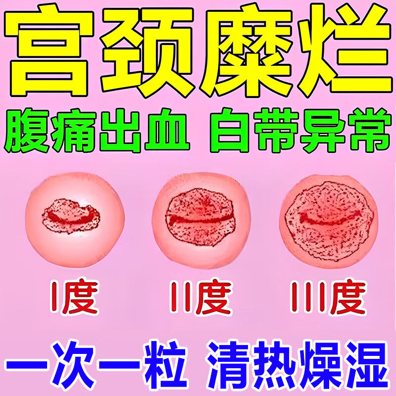 宫颈糜烂重度专用中药妇科炎症专用药纳氏囊肿抗宫炎片官方旗舰店