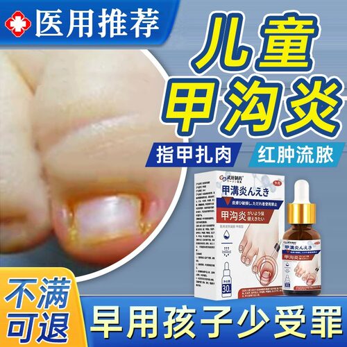 儿童甲沟炎治疗特效灰指甲膏息肉