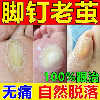 脚钉祛除膏去除厚脚垫老茧死皮根去脚底板脚掌趾指头Y硬皮软化剂
