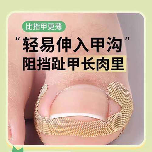 甲沟神器指甲矫正器嵌甲专用拉贴隔离脚趾甲长肉里填充垫片纠正炎