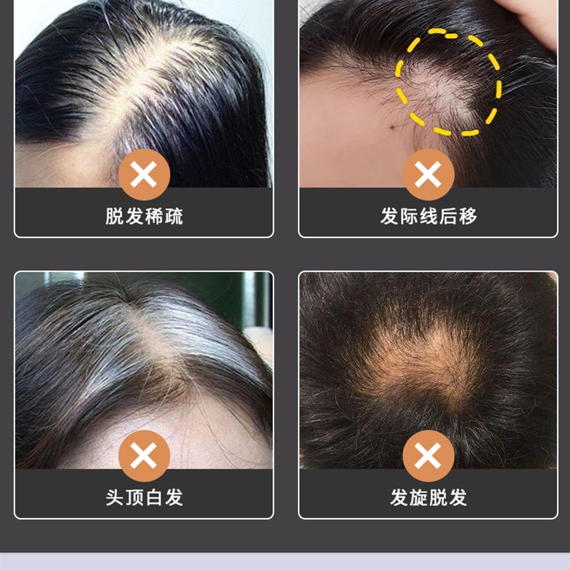 假发片女头顶补发片全真发妈妈中老年增发量遮白发轻薄透气补发块
