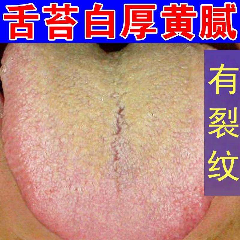 舌苔黄厚腻舌头裂纹有齿痕发白口臭口干调理脾胃健祛湿气重肠胃贴