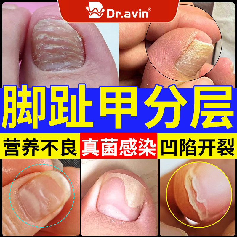 Dr.avin脚趾甲分层空甲搽剂修甲床分离复液指甲凹陷裂真菌感染HY
