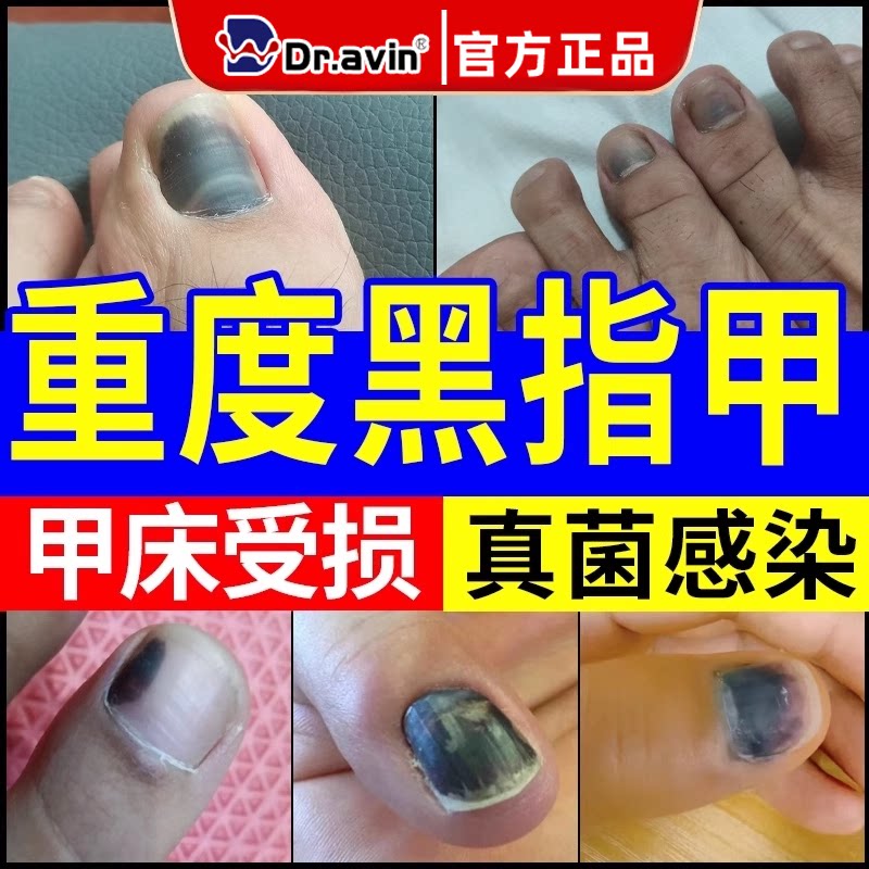 黑指甲脚指专用甲变黑发黑淤血发黑痣可搭膏药贴甲母痣黑线挤压CS