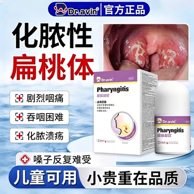 代文戴监制化脓性扁桃体