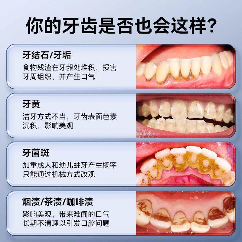 仪国家用可视化洁牙真超音波洗牙器toothsi去除牙结石神器德牙除