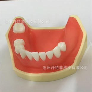 种植练习模型 种植牙缺失模型 牙齿种植模型