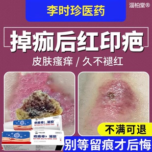 摔伤擦伤结痂掉痂后去红印黑印修复疤痕膏淡化疤痕止痒愈合HV