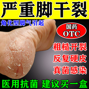 主治角化型脚气脚后跟干裂起硬皮足跟开裂脱皮杀菌真菌感染专用药