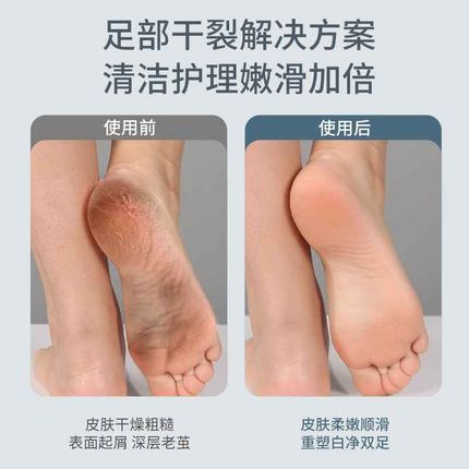 2025新款电动修脚器充电式自动磨脚器去死皮老茧神器脚后跟打磨器