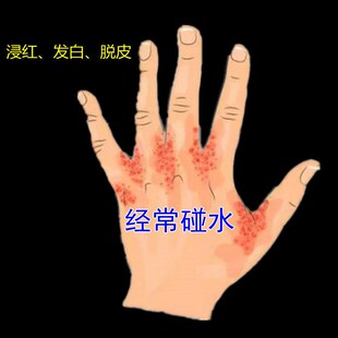 经常碰水手指缝溃烂糜烂手指间烂红肿开裂发红脱皮痒烂长时间泡水