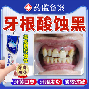 牙齿酸蚀牙根腐蚀变黑脱矿釉质楔状缺损修黑斑去除复含氟搭牙膏根