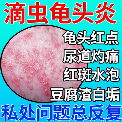 滴虫性龟头炎症龟头小红点尿道灼疼痛红斑水泡包皮下面豆腐渣白垢