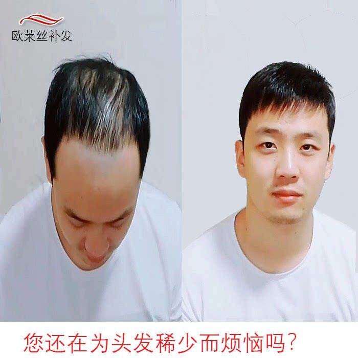 西安补发织发片真人假发仿生头皮发块生物隐假发真发男士假发逼真