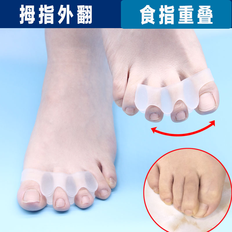 大脚趾矫正器拇指外翻食s指重叠上翘二脚趾压大拇指大脚骨分离分