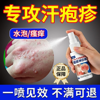 手指手上起小水泡孢疹汗状疱疹止痒汉状真菌感染脱皮干裂专用软膏