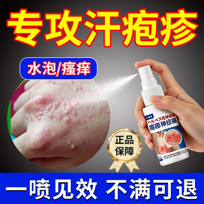手指手上起小水泡孢疹汗状疱疹止痒汉状真菌感染脱皮干裂专用软膏