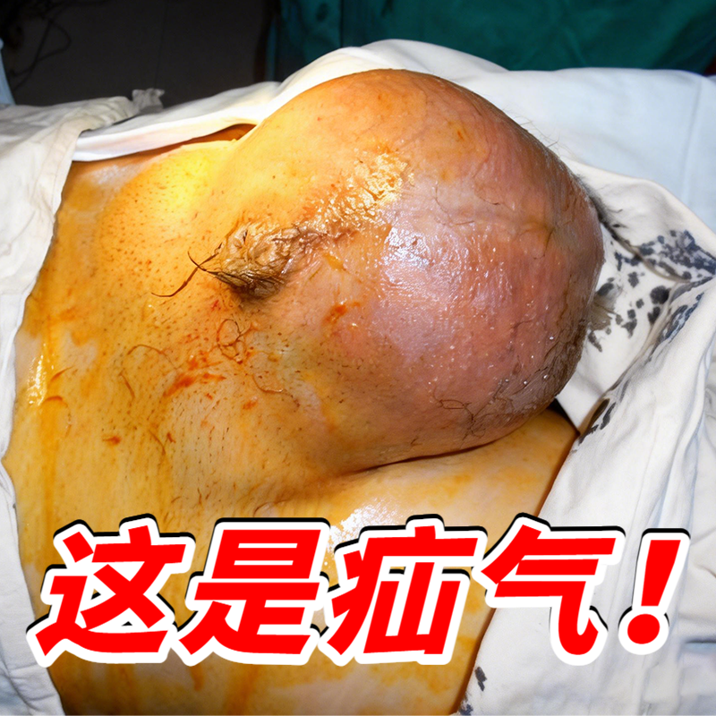 疝气贴腹股沟中老年人专用膏凸肚脐托腹带成人治疗特效斜疝肚脐贴