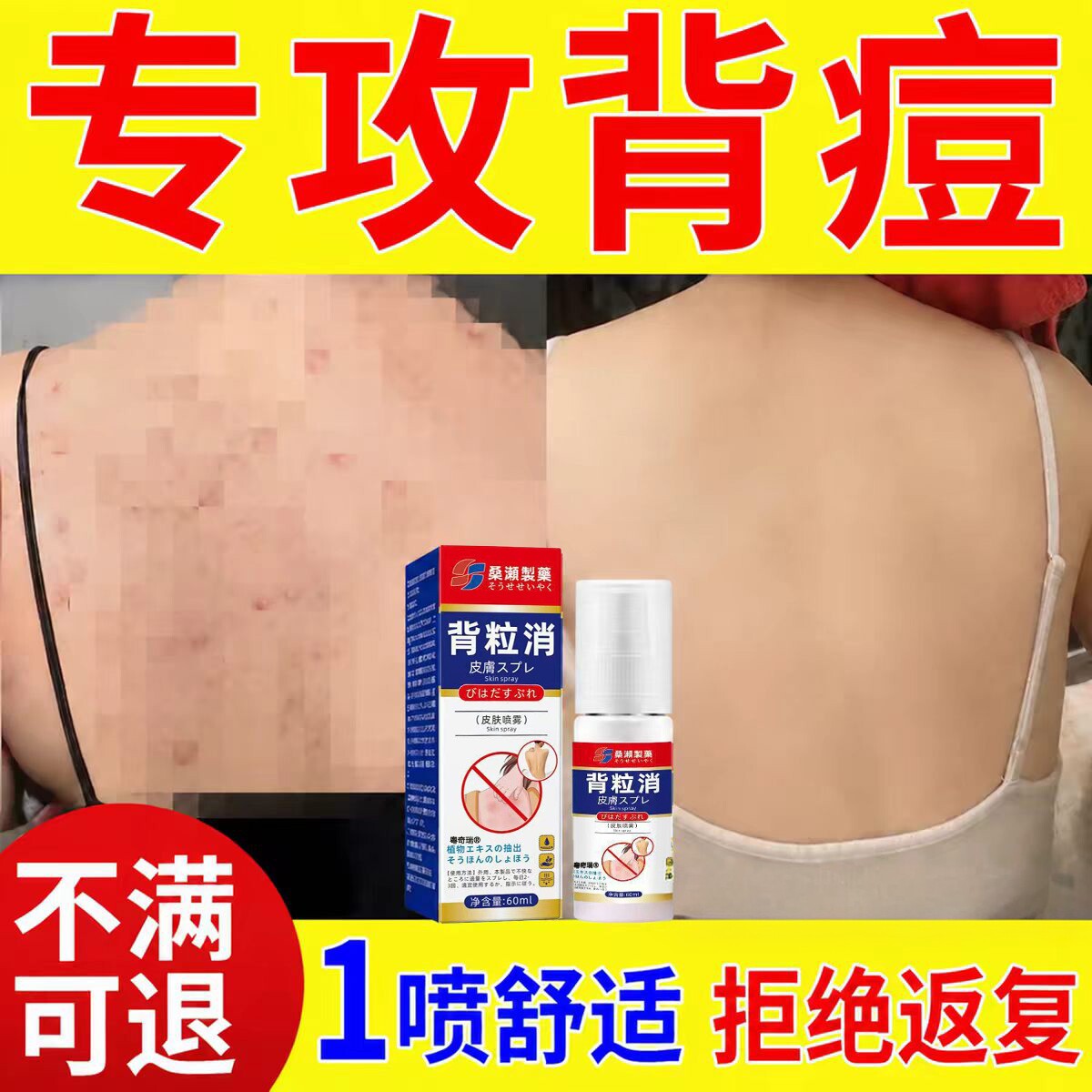 前胸后背毛囊痘一喷光滑