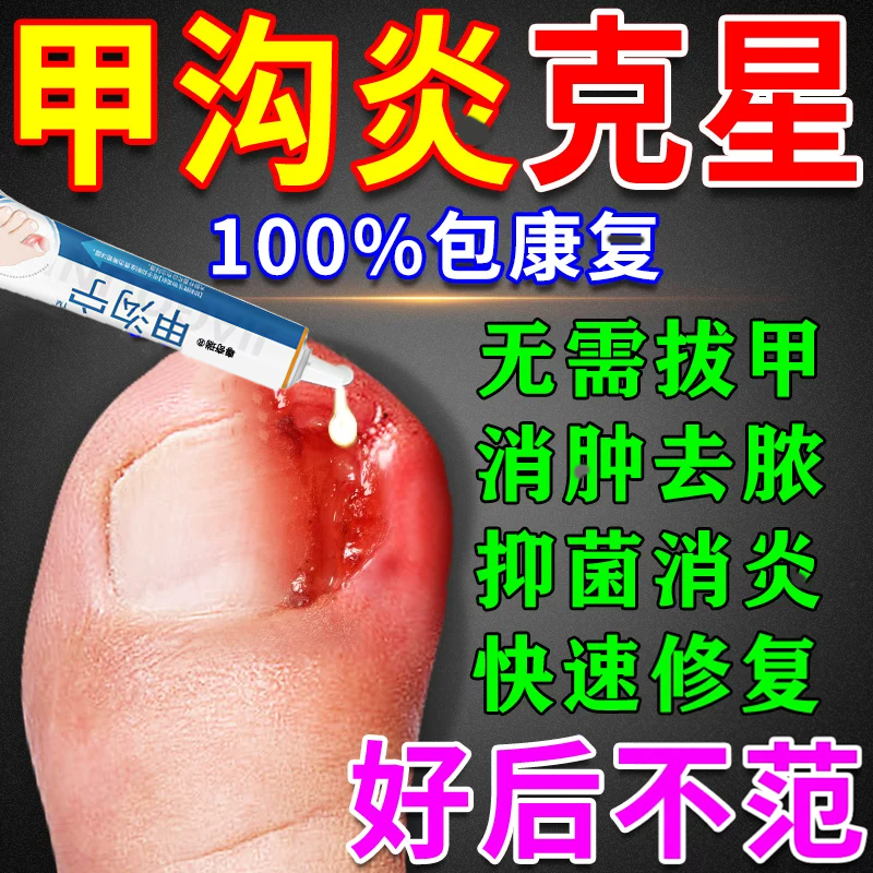 甲沟宁脚趾甲沟矫炎正器流脓息肉内嵌软化剂灰指脱甲膏凤仙花抑菌