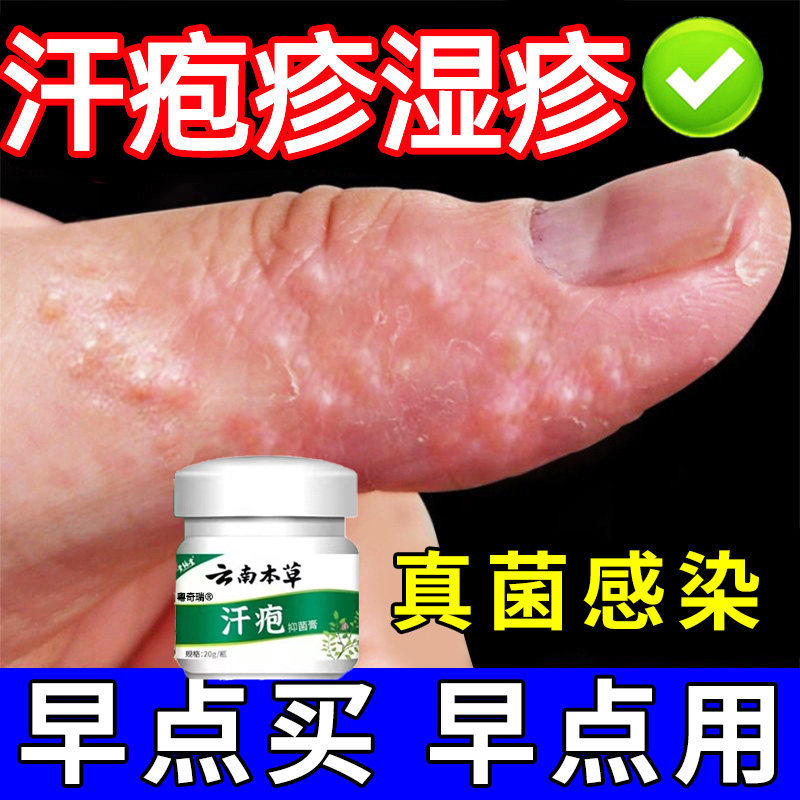 【速拔汗疱疹】好后不范