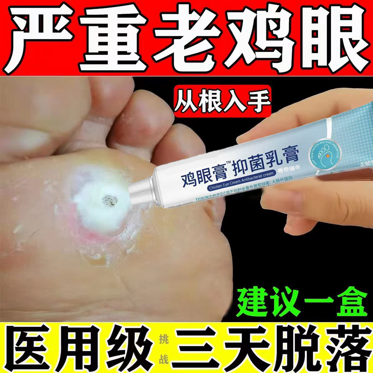【三天看脱落】医用级鸡眼膏