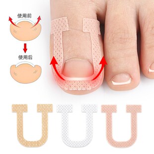 U型指甲贴甲沟内卷弹力拉伸无胶水嵌甲脚趾垫美甲调整矫形贴片
