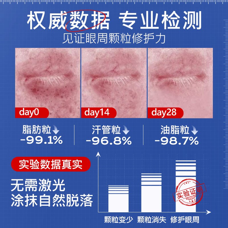 眼部脂肪粒去除神器眼霜油脂粒汗管瘤眼周眼角男女士祛专用旗舰店
