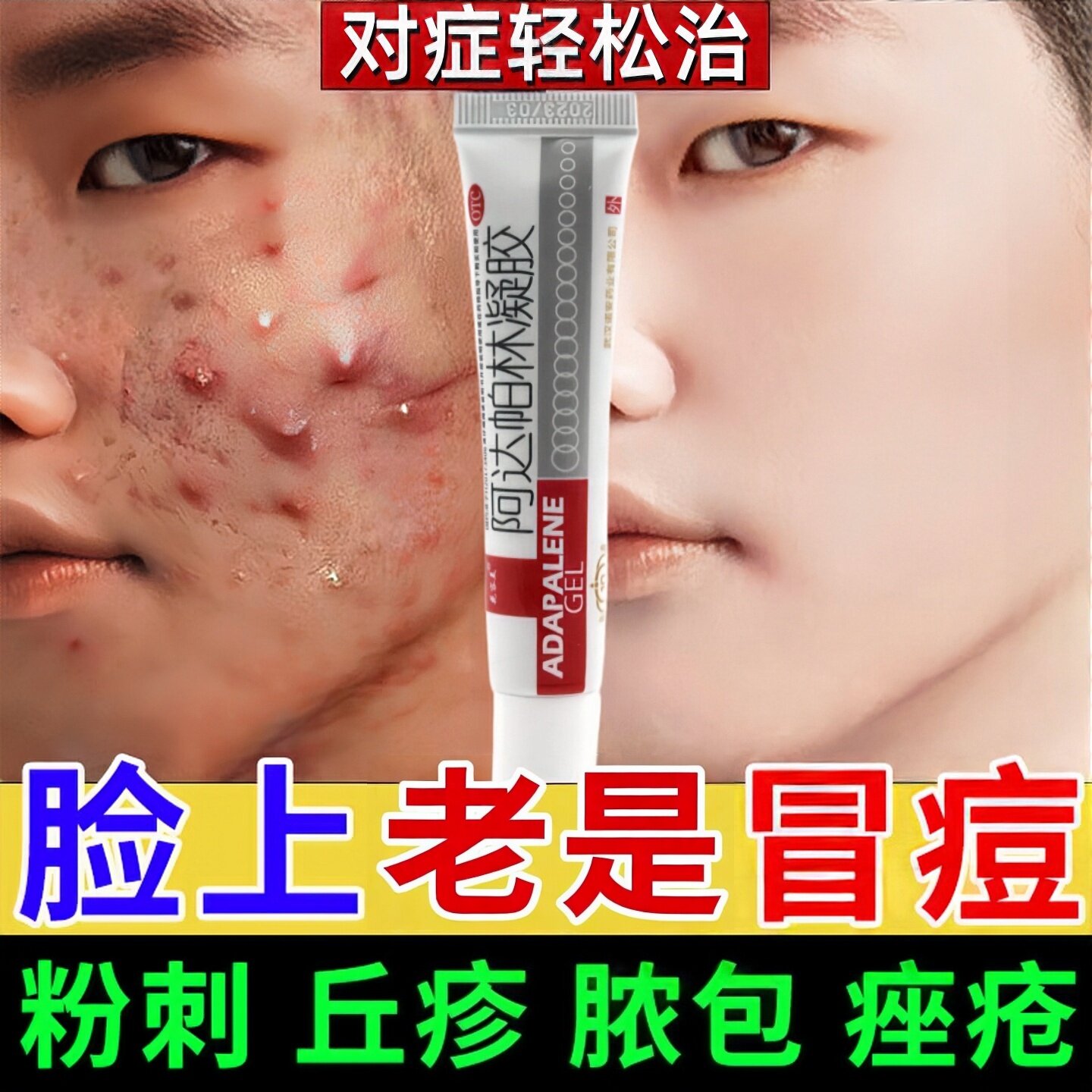 阿达帕林凝胶正品医用痤疮膏去黑皮脂汗腺