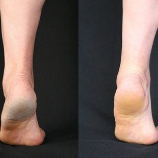 韩国进口修脚神器去死皮家用脚后跟刮脚底磨脚挫脚皮打磨器搓脚板