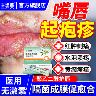 嘴唇单纯疱疹嘴巴上火起泡烂嘴角病毒特药监备案效开裂口角炎JQ