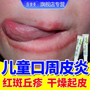 儿童口周皮炎嘴巴周围发红嘴角干燥起皮补水舌舔唇炎润唇搭药膏QN