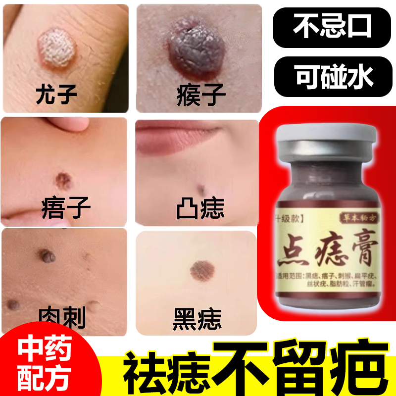 点痣痦子膏去脖子小肉粒尤猴去除抑菌液腋下皮扁平尤祛丝状尤