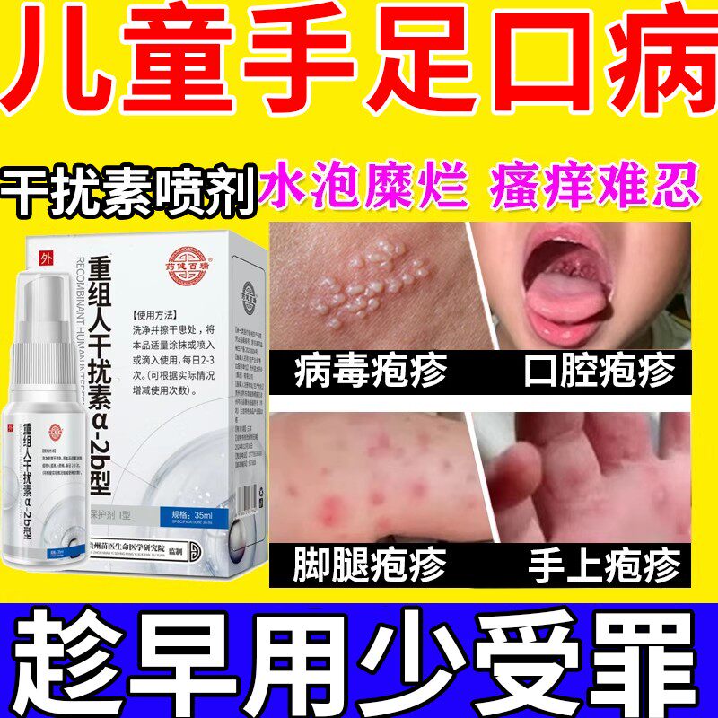 手足口病搭药膏重组人工干扰素a2b喷雾剂儿童疱疹性咽峡炎口腔α