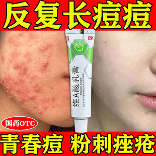 祛痘药膏后背部祛闭口粉刺凝胶脸上起痘痘治痤疮药膏重度暗疮内服