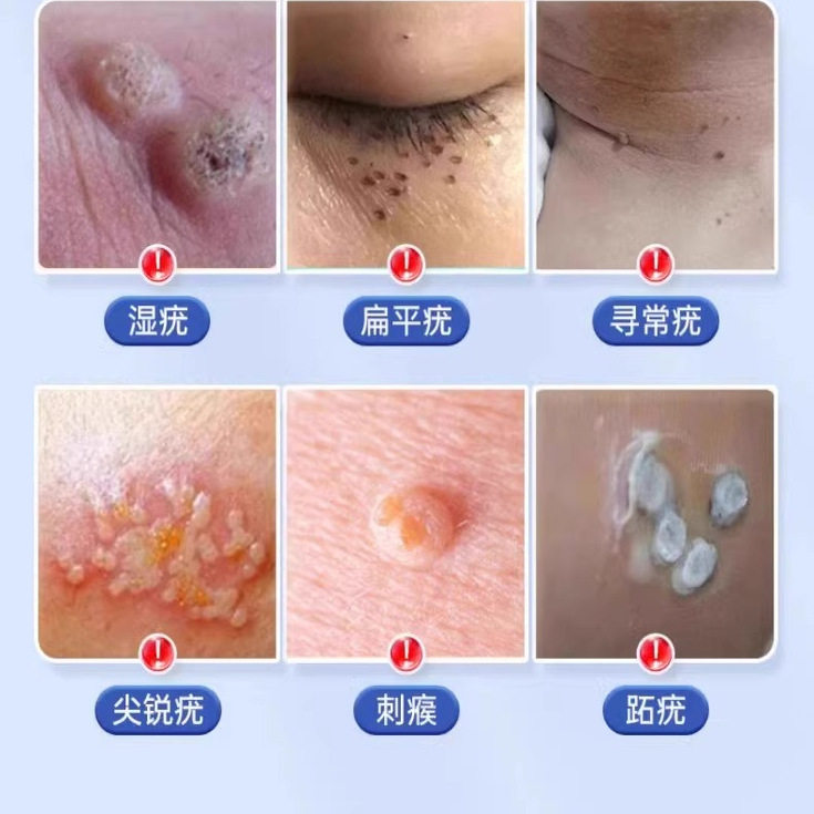 扁平疣祛除药膏疣瘊子药水尤脖子上长小肉粒一抹灵无忧斩草除根 9