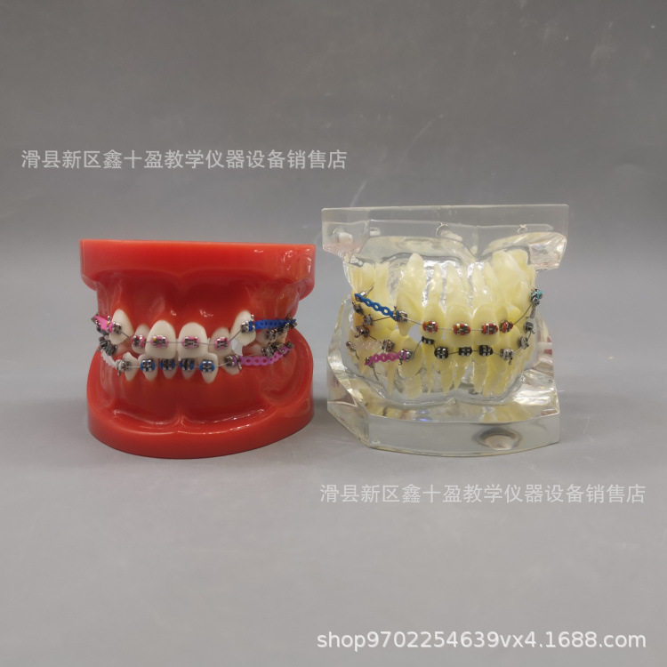 牙齿正畸模型 缺失牙错颌牙列不齐矫正 金属托槽带支抗牵引皮拉链
