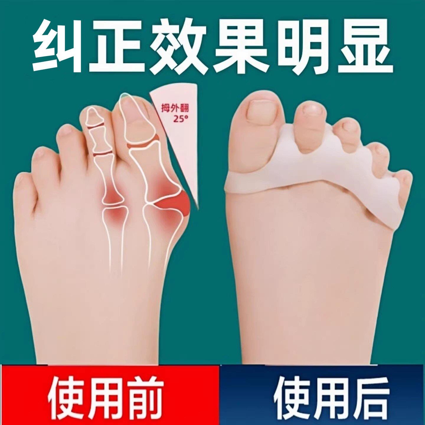婴儿幼儿童脚趾矫正器小孩大拇指重叠外翻弯曲畸形矫形纠正分趾器