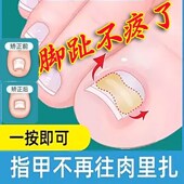 正甲贴甲沟炎嵌甲矫正免胶水矫正正甲贴片脚趾变形指甲新款 长肉里